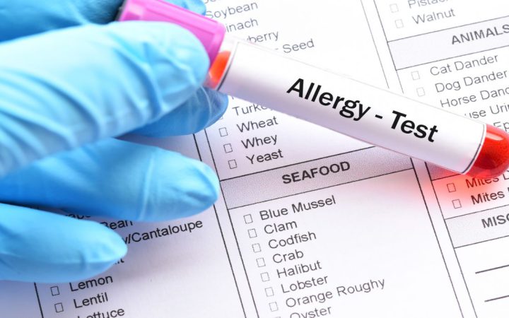 Gıda Alerji Testi Nasıl Yapılır?