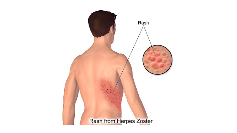 Zona (Herpes Zoster) Nedenleri 