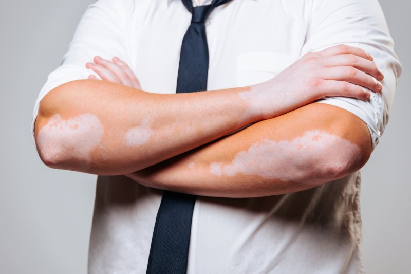 Vitiligo Başlangıcı 