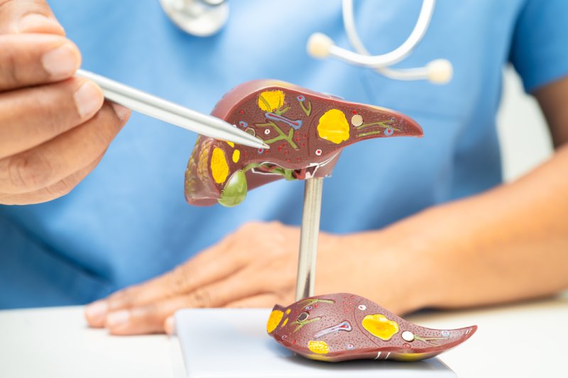 Safra Taşlarının Nedenleri 