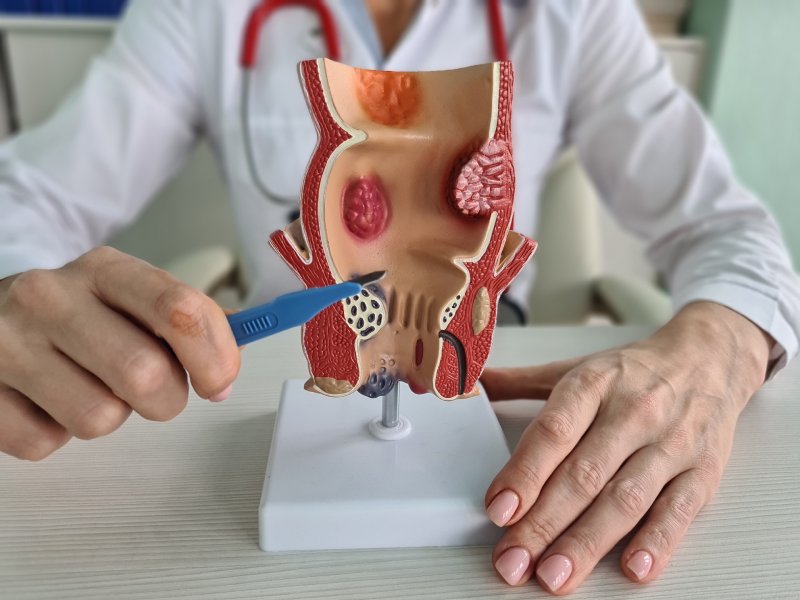 Basur Hastalığında Tedavi